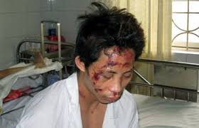 Chấn thương vùng mặt - Hình ảnh minh họa